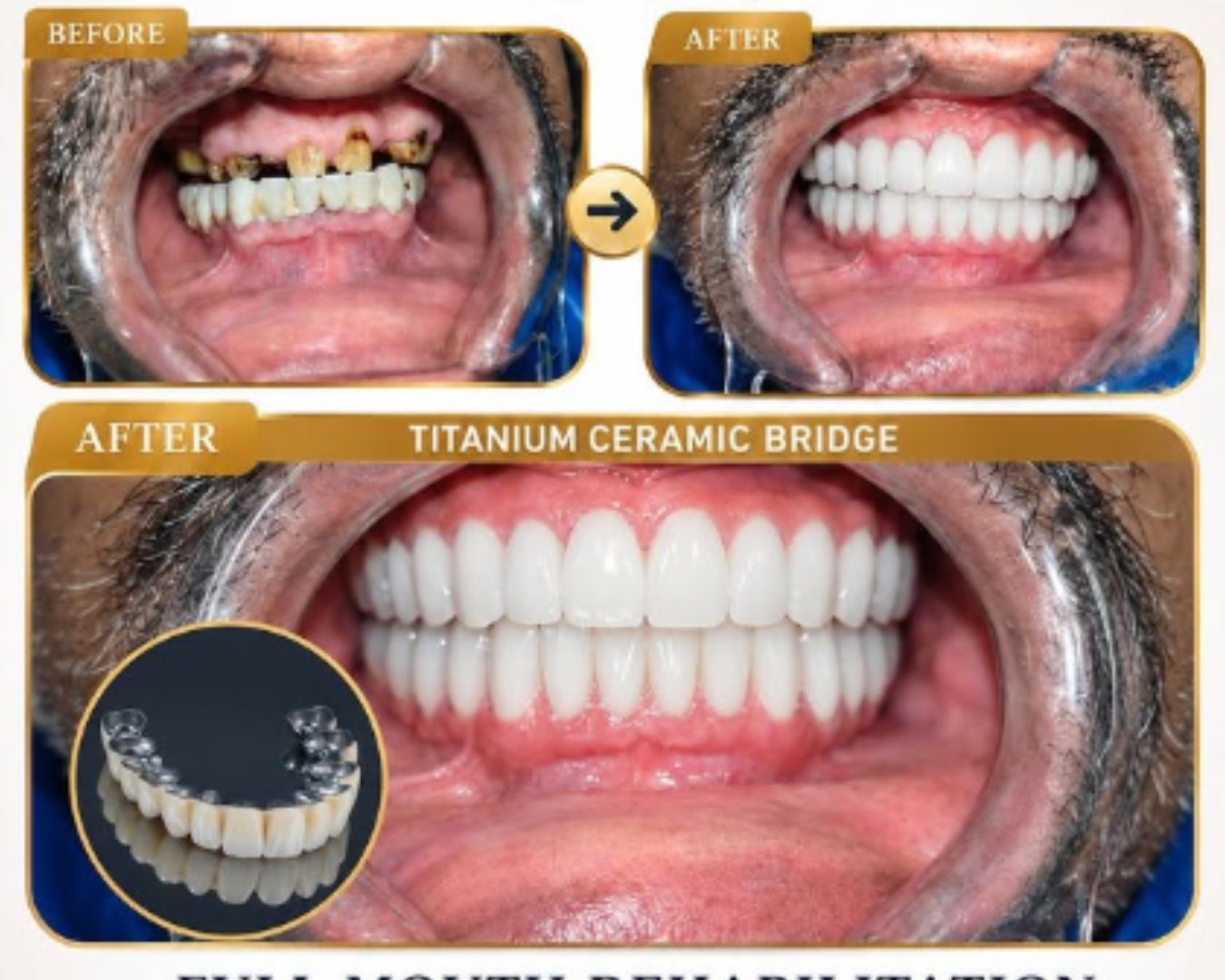 Dental implant and crown work
