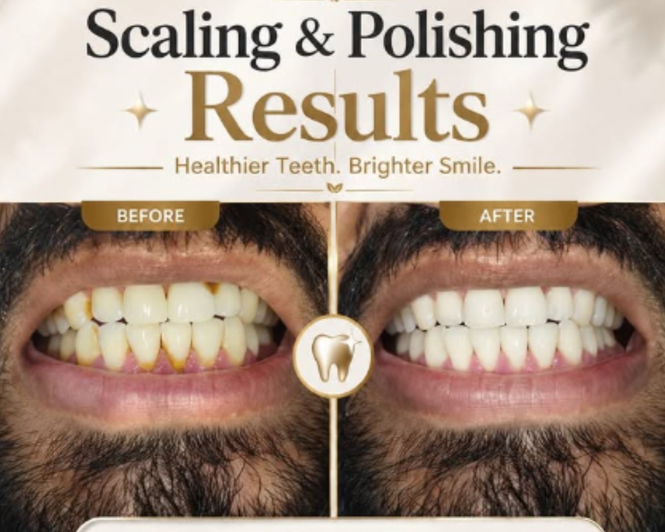 Veneer shade matching