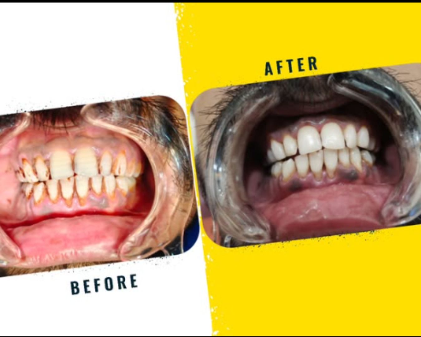 Pediatric dental care